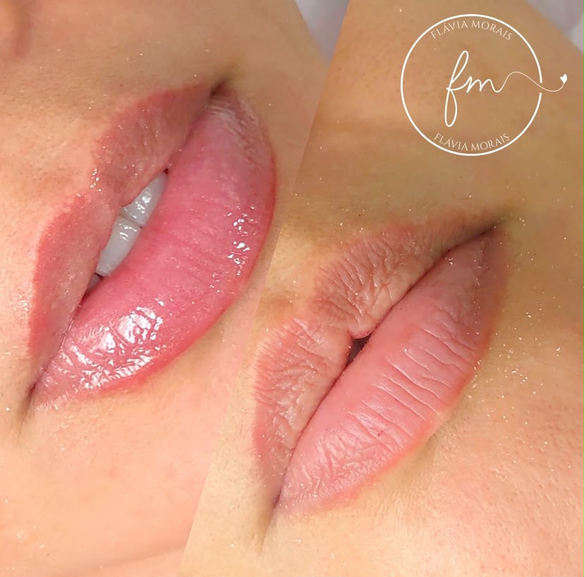 Procedimento Hydra Gloss Lips